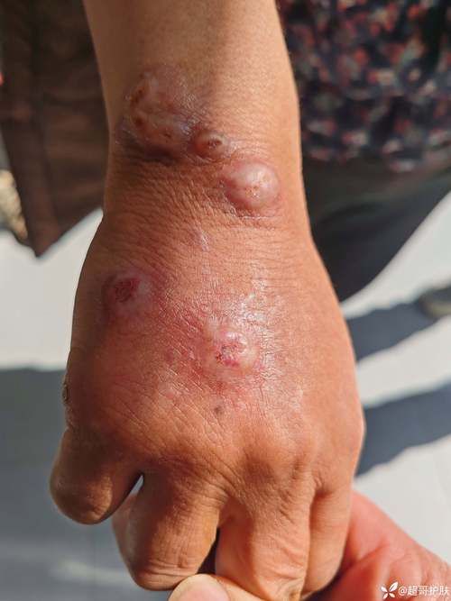 固原：六盘山屏障下的低感染样本_6230