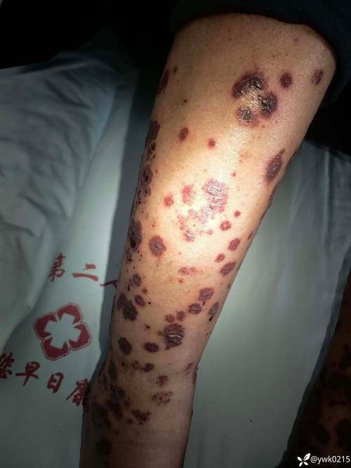 华坪县：滇北高原屏障下的低感染样本_51336