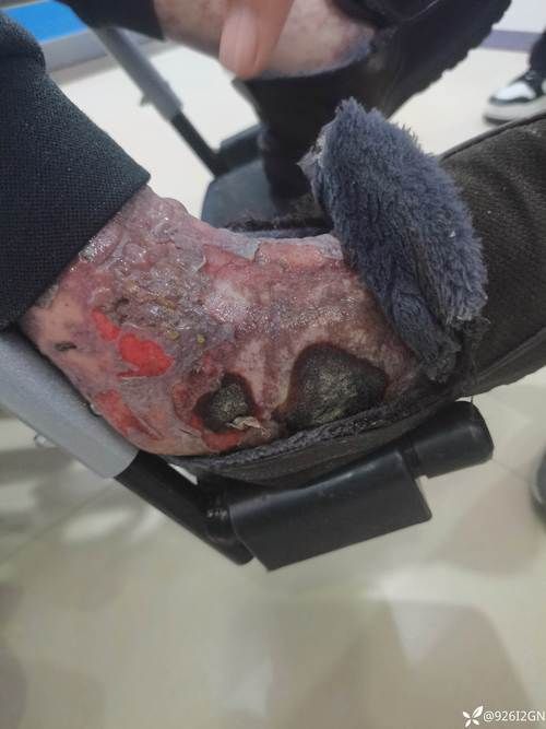 平远：粤东山区屏障下的低感染样本观察